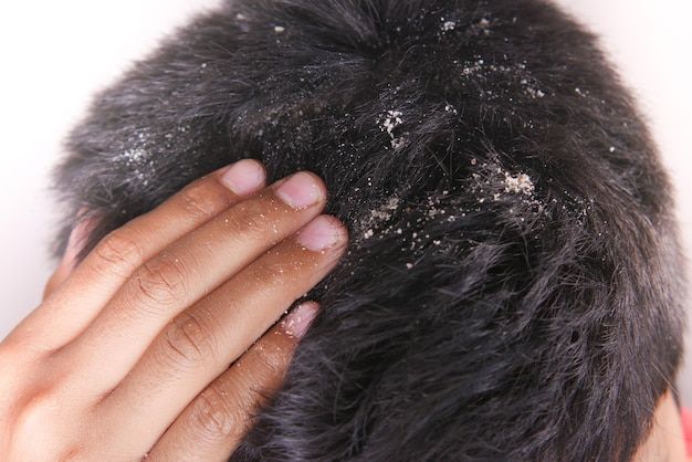 Natural Solutions for Dandruff & Itchy Scalp: Understanding What Your Scalp Really Needs